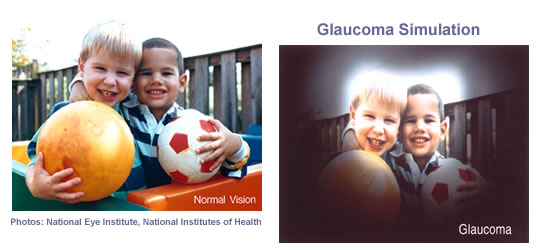 glaucoma